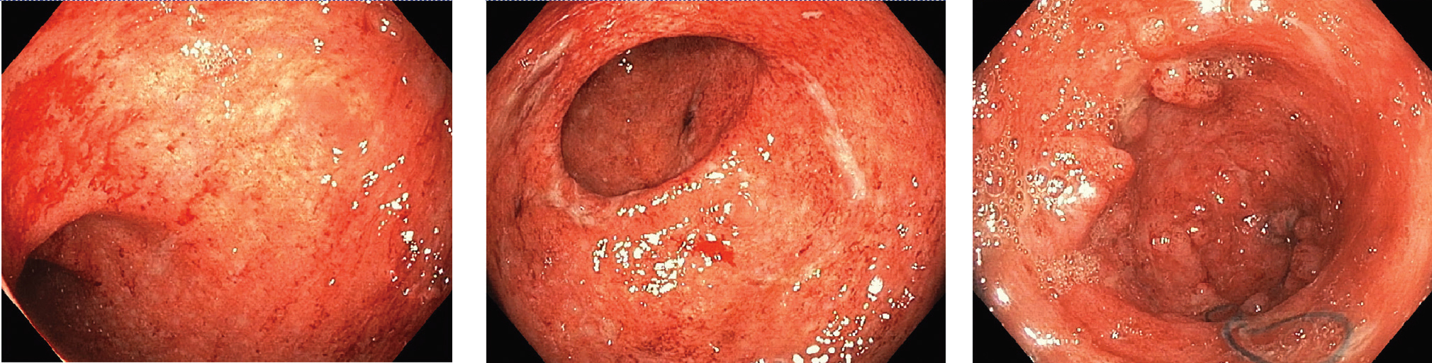 RCP médicochirurgicale MICI