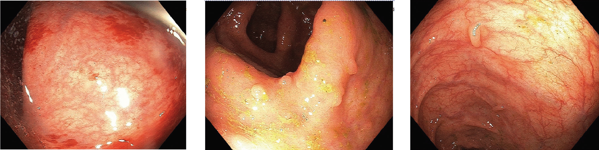 RCP médicochirurgicale MICI