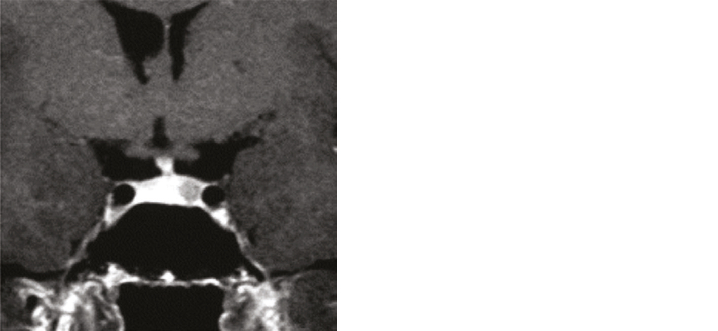 Cas clinique Microprolactinome