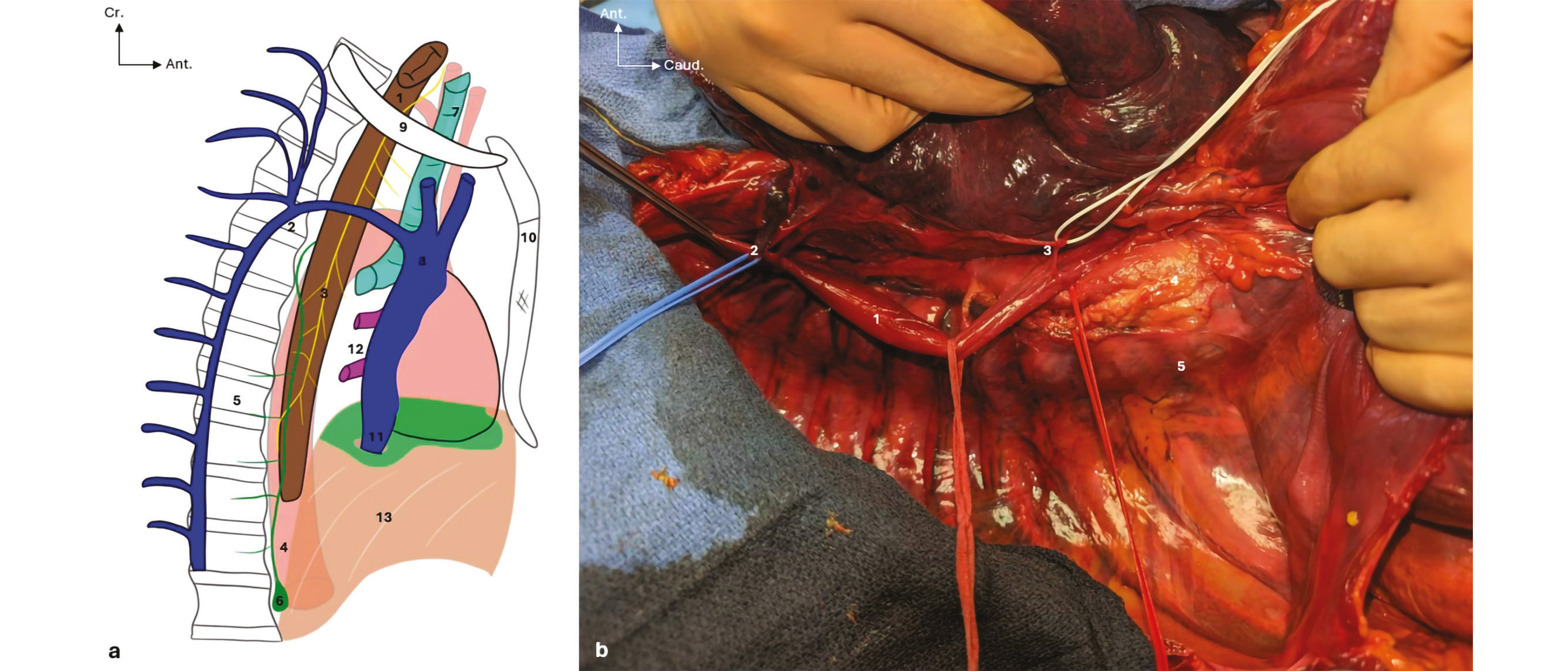 Bases anatomiques de la chirurgie oesogastrique