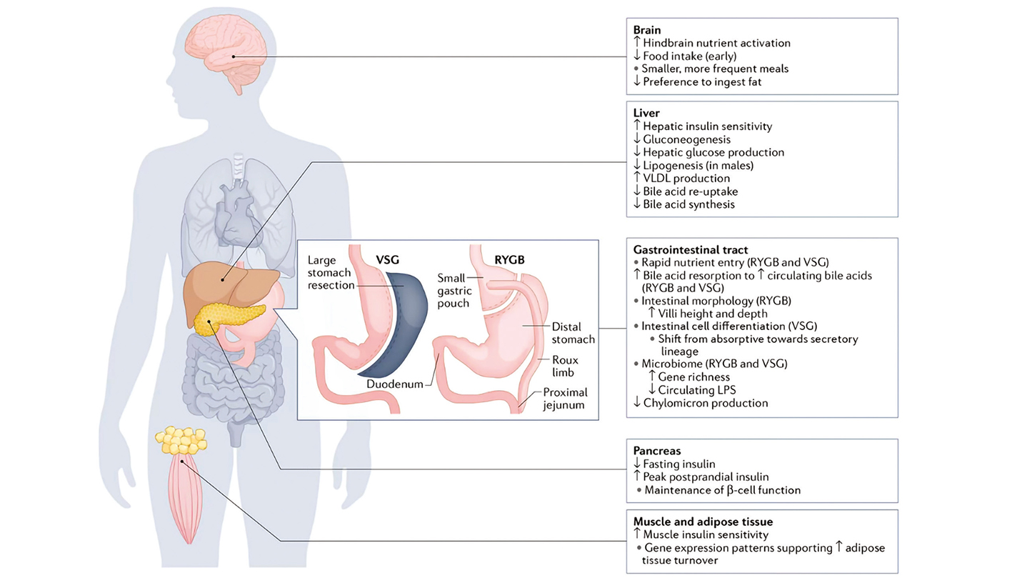Chirurgie métabolique-bariatrique - Quand la chirurgie reprogramme le métabolisme