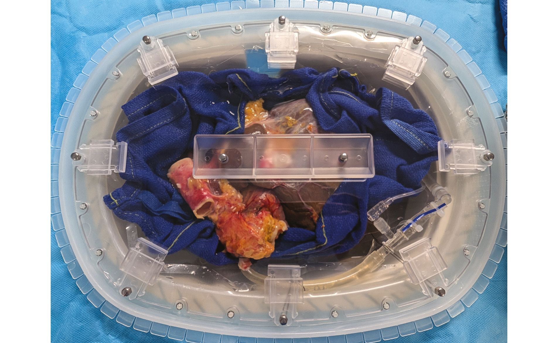 Machine de perfusion hépatique, kézako ?