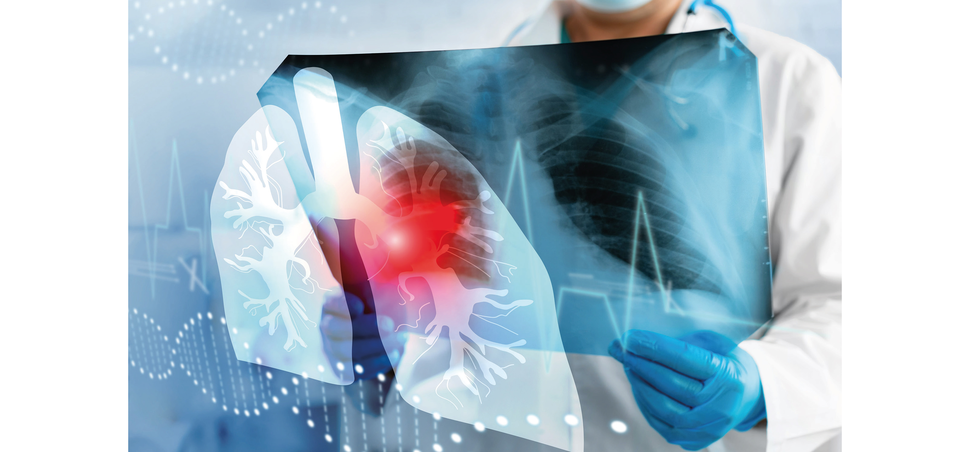 Oncologie thoracique