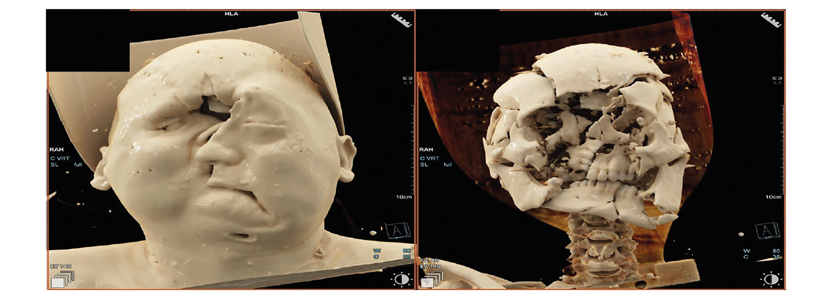 Recommandations pour l’interprétation du scanner post mortem (PMCT)