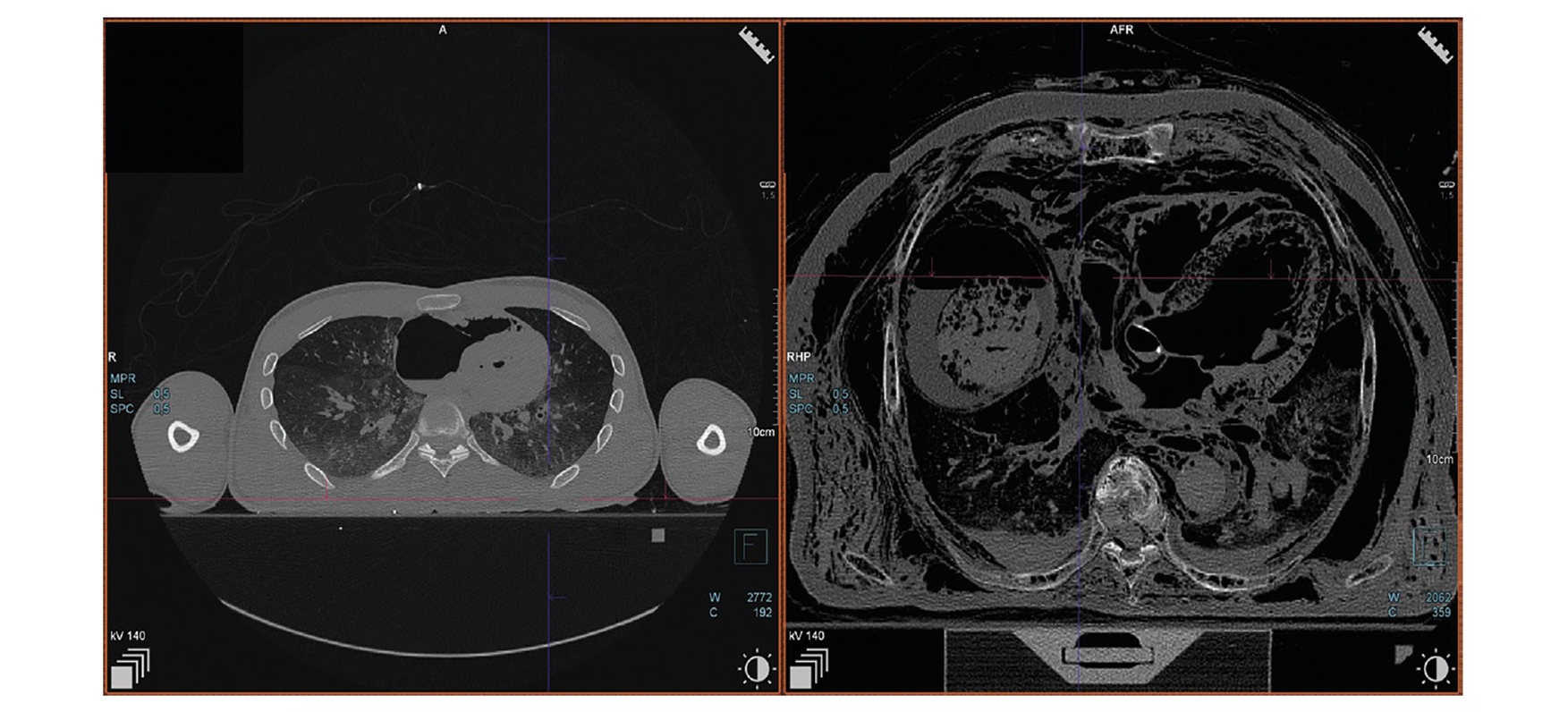 Recommandations pour l’interprétation du scanner post mortem (PMCT)