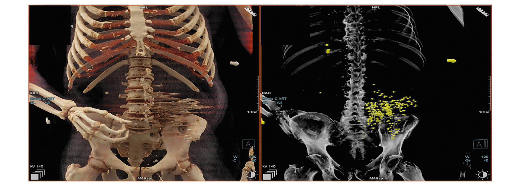 Recommandations pour l’interprétation du scanner post mortem (PMCT)