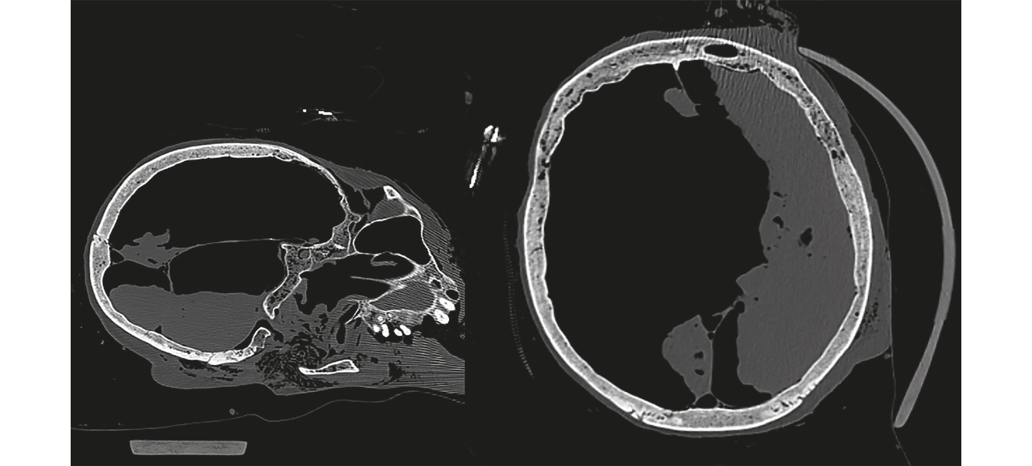 Recommandations pour l’interprétation du scanner post mortem (PMCT)