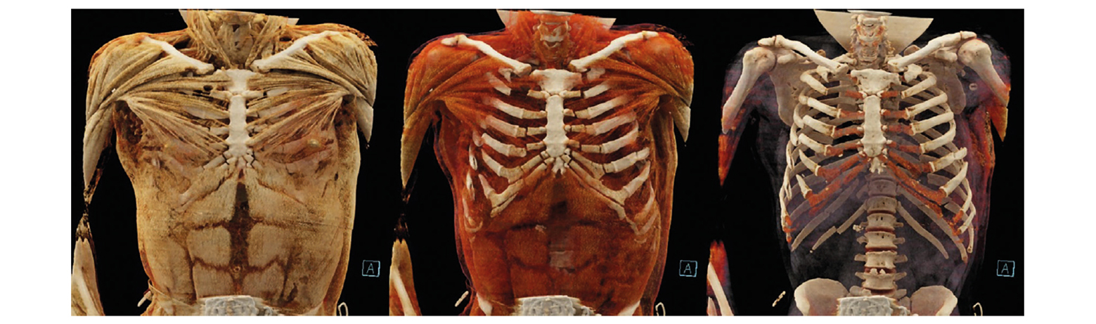 Recommandations pour l’interprétation du scanner post mortem (PMCT)