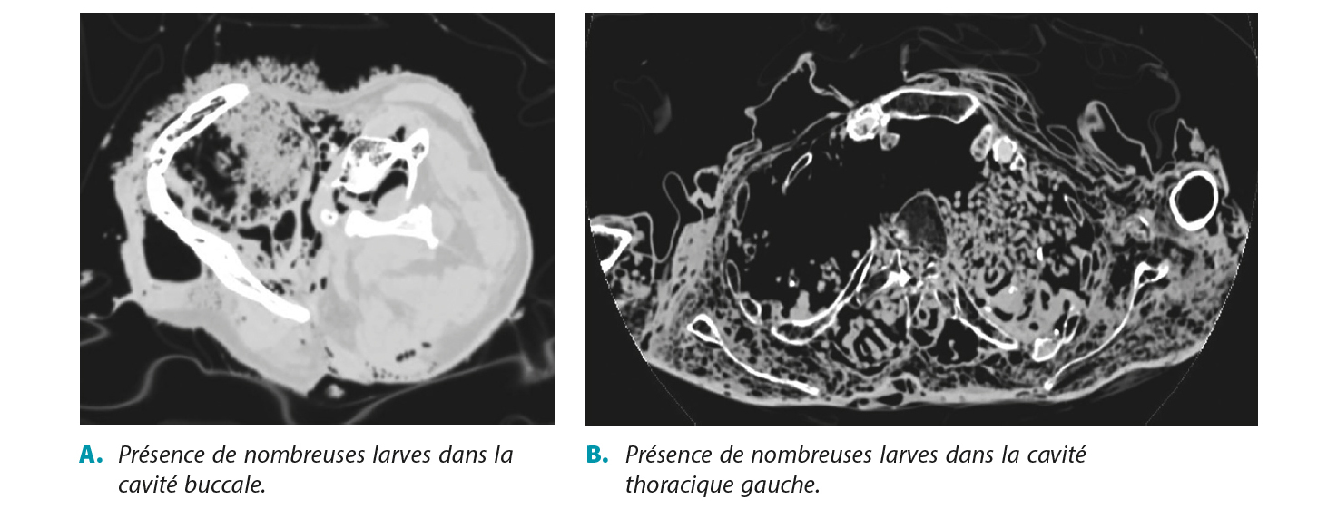 Les « artéfacts » post-mortem au scanner à connaitre : thanatomorphose et autres réjouissances