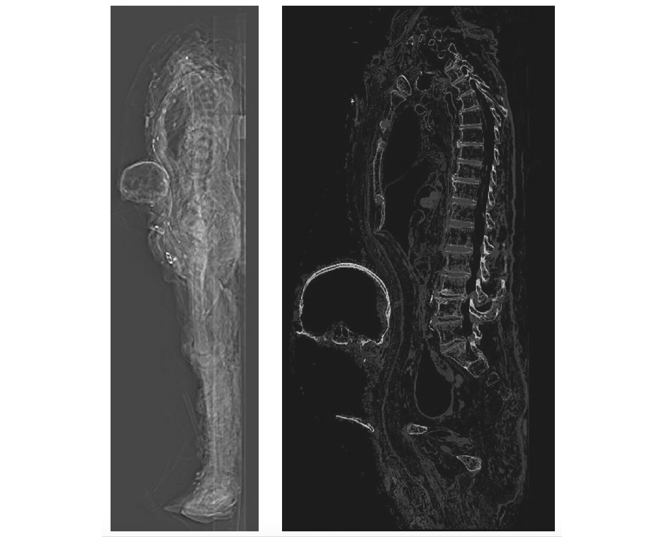Les « artéfacts » post-mortem au scanner à connaitre : thanatomorphose et autres réjouissances